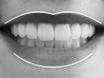 Perfect Smile lips